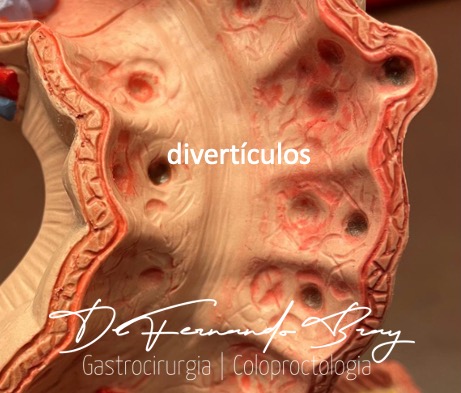Figura 1: Ilustração demonstrando os divertículos do intestino grosso.