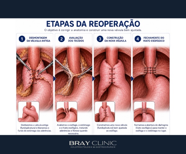 Você fez cirurgia de refluxo e não está bem? Entenda a reoperação