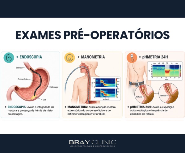 Entenda como é a cirurgia do refluxo gastroesofágico
