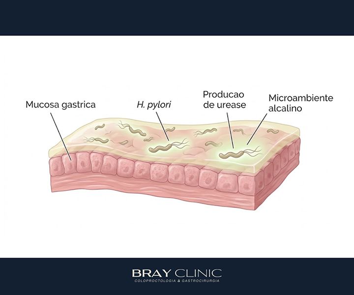 H. pylori: o que mudou no tratamento e como erradicar a bactéria