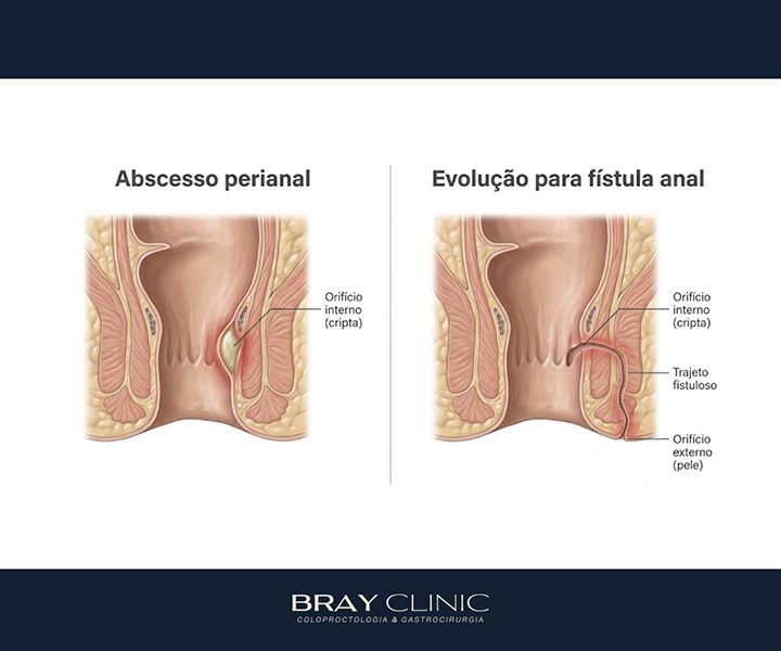 Abscesso perianal: como reconhecer os sintomas e agir a tempo