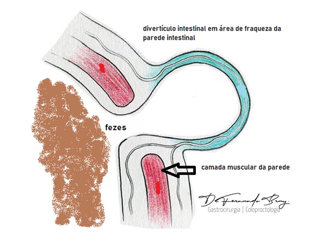 Figura 2: Ilustração da fina parede do divertículo de cólon.