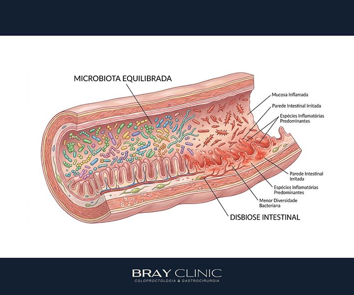 Disbiose intestinal: o desequilíbrio que afeta muito além da digestão