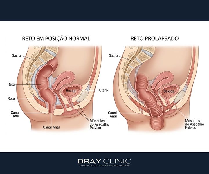 Prolapso retal: da primeira percepção do problema ao tratamento definitivo