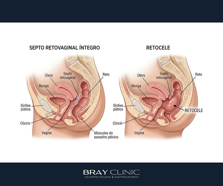 Cirurgia de retocele: o guia completo sobre técnicas, indicação e recuperação
