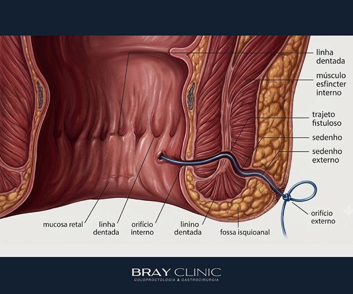 Fístula anal na doença de Crohn: por que é tão frequente e como tratar de forma eficaz