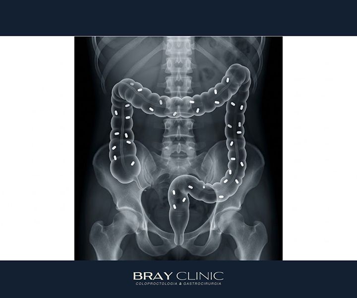 Como tratar a inércia colônica e devolver o movimento ao intestino