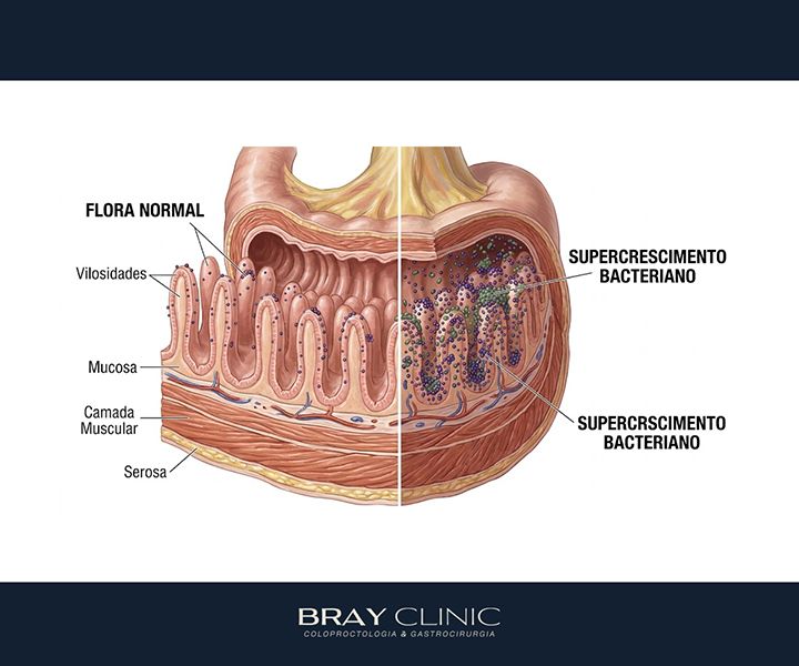 SIBO: entenda o supercrescimento bacteriano no intestino delgado e saiba como tratar