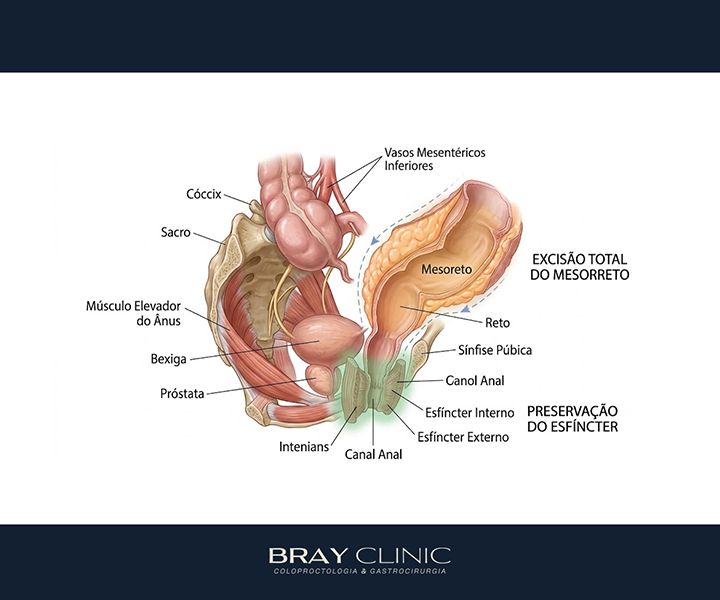 Câncer de reto: do diagnóstico à cirurgia, o que realmente esperar do tratamento