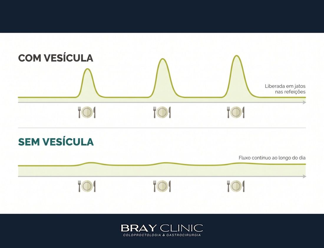 Vida sem vesícula: como o corpo se adapta e o que fazer para a digestão voltar ao normal