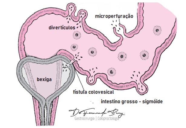 Figura 4: Divertículos do intestino grosso com demonstração de duas complicações: microperfuração da diverticulite e uma fístula do cólon com a bexiga.