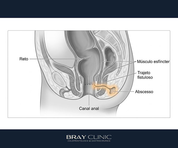 Doença de Crohn perianal: o que acontece quando a inflamação atinge a região anal?