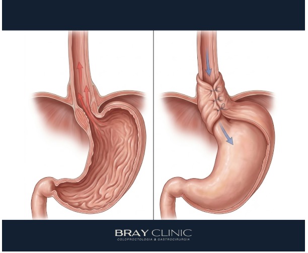 Entenda como é a cirurgia do refluxo gastroesofágico