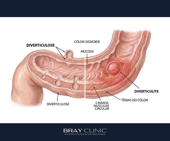 Doença diverticular do cólon: entenda o que são os divertículos e quando eles se tornam um problema