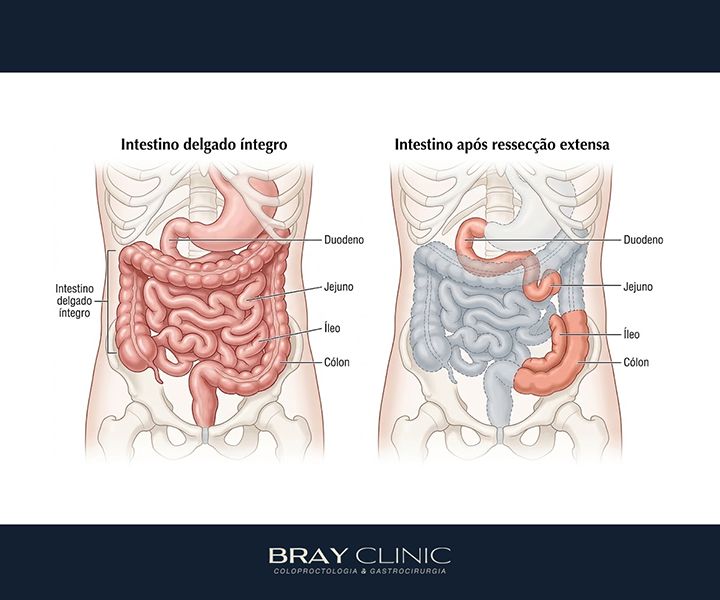 Síndrome do intestino curto: o que muda no corpo após a cirurgia e como se adaptar
