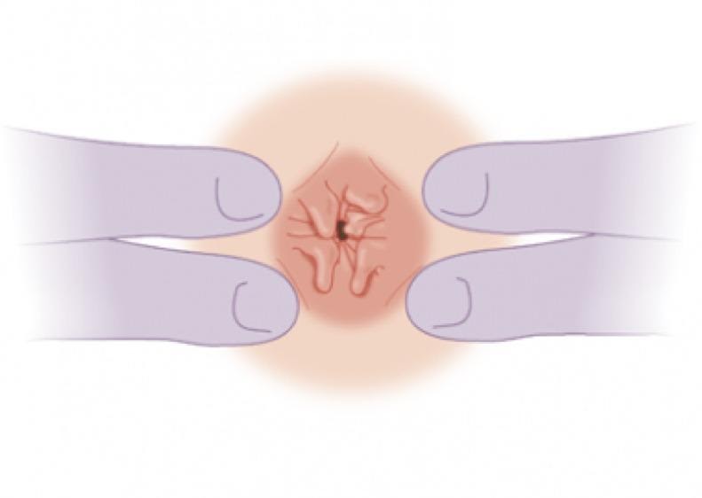 Exame de Plicoma Anal