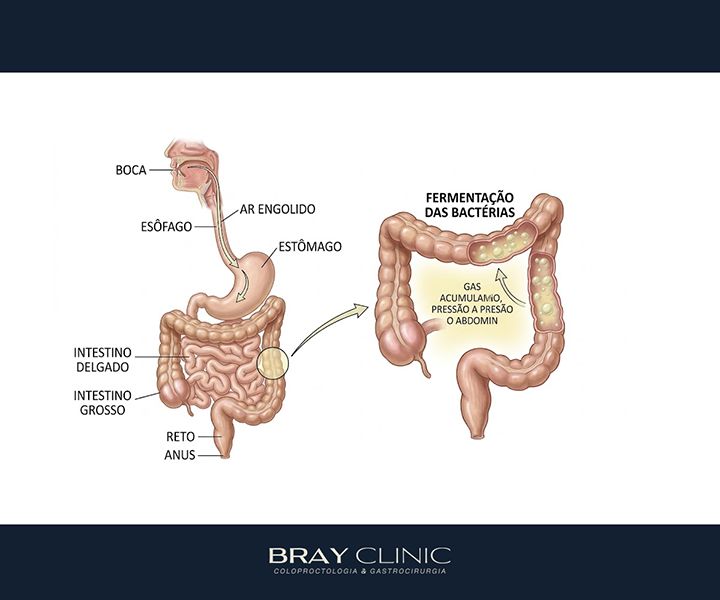 Barriga inchada, entenda o que está por trás do estufamento e como desinchar de verdade