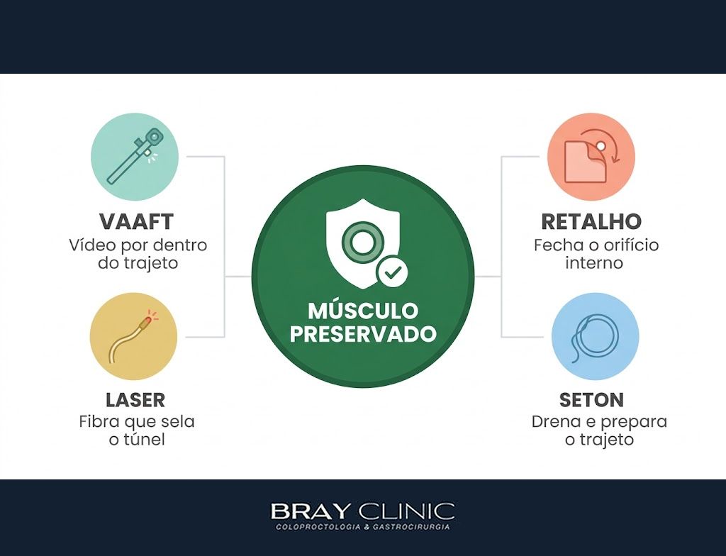 VAAFT, a cirurgia que trata a fístula anal por dentro e preserva a continência
