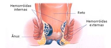 Hemorroidas: tratamento sem cirurgia e como aliviar os sintomas