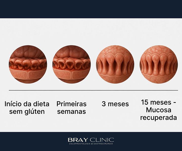 Doença celíaca: entenda a condição autoimune e saiba como recuperar a saúde intestinal