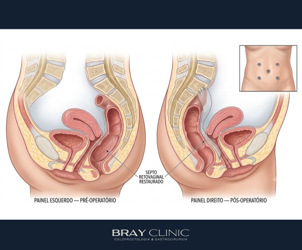 Sensação de "bola" na vagina ou no ânus ao evacuar? Saiba o que é retocele
