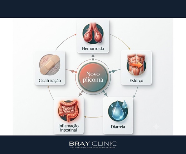 Por que os plicomas anais podem voltar depois da cirurgia?