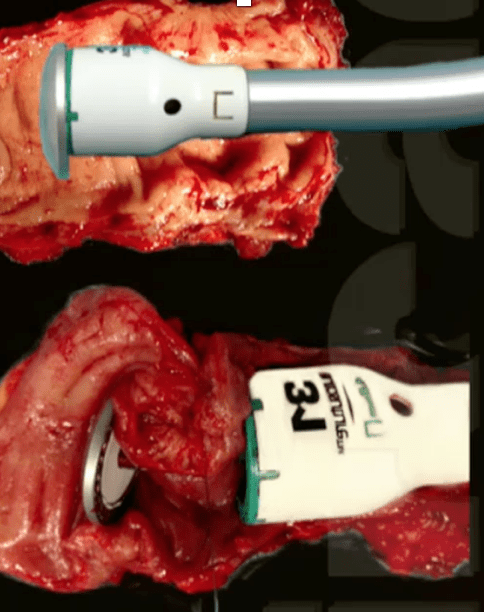Quais os tipos de cirurgia para endometriose profunda intestinal2