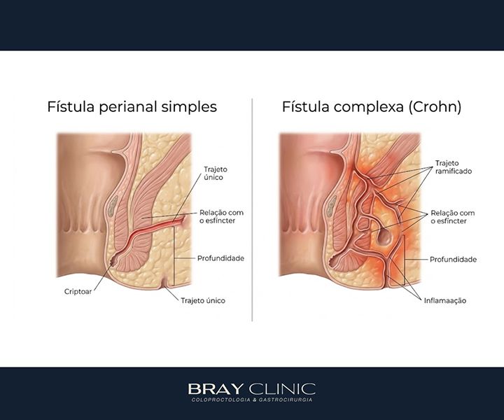 Doença de Crohn perianal: o que acontece quando a inflamação atinge a região anal?