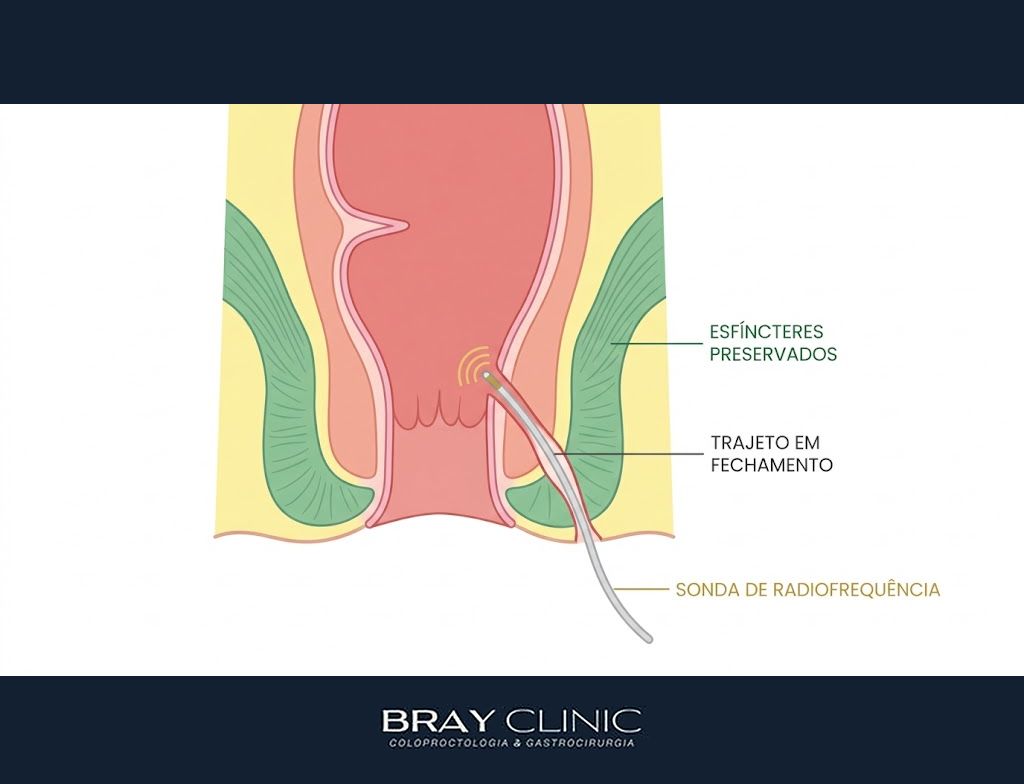 Radiofrequência na proctologia, entenda a nova energia dos tratamentos anorretais
