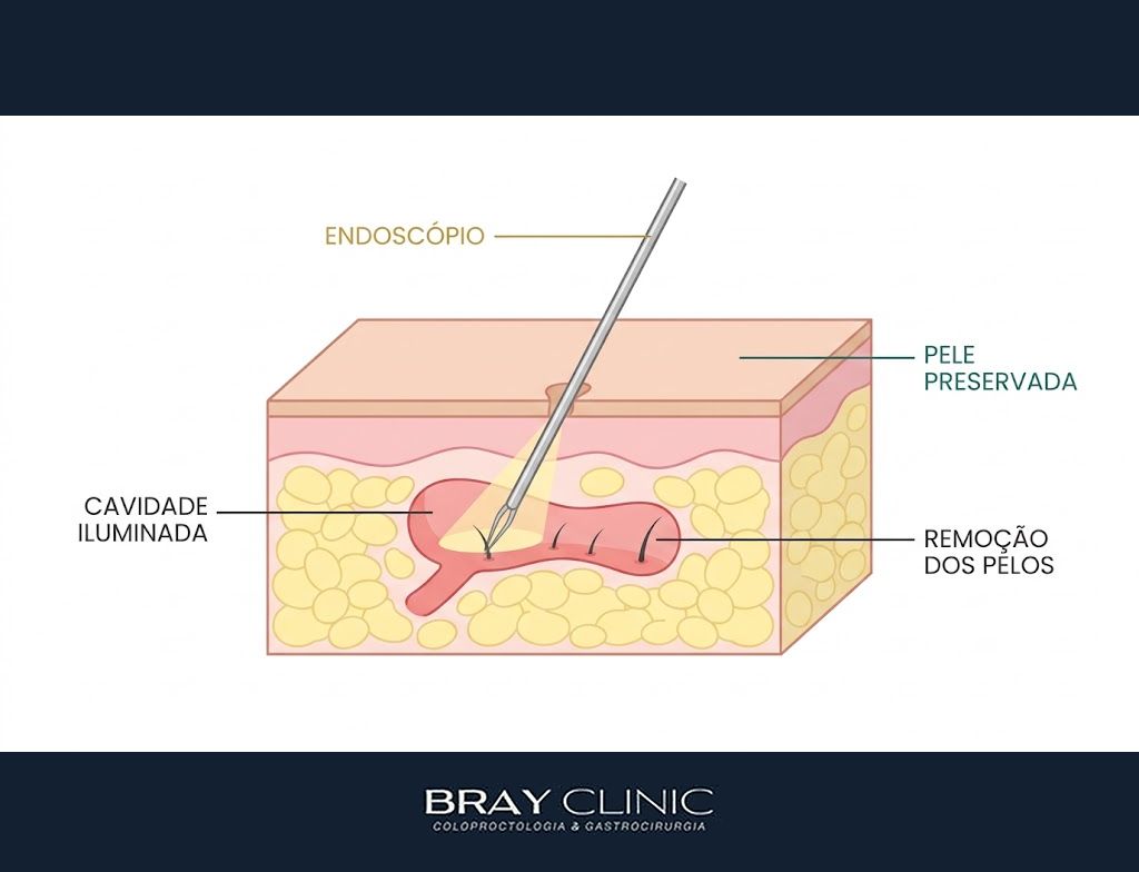 EPSiT, a cirurgia por vídeo que trata o cisto pilonidal sem grandes cortes