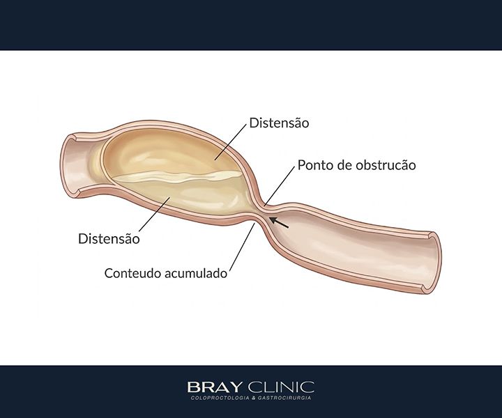 Obstrução intestinal: o que causa, quais os sintomas e como é o tratamento