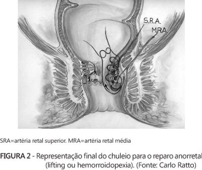 5 técnicas de cirurgia para hemorroidas para um pós-operatório com menos dor