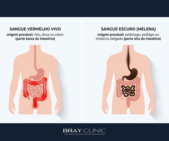 Sangue nas fezes: entenda as causas e saiba quando buscar ajuda médica