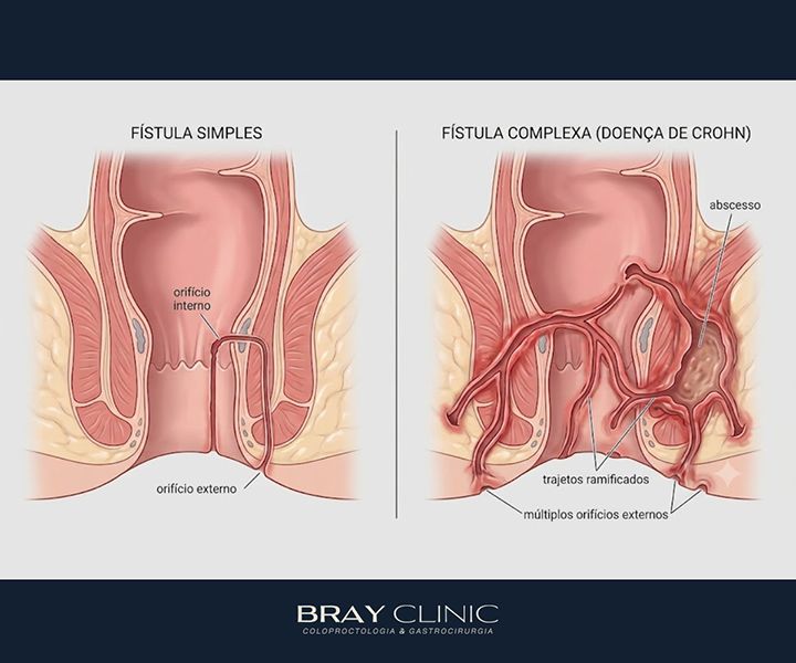 Fístula anal na doença de Crohn: por que é tão frequente e como tratar de forma eficaz