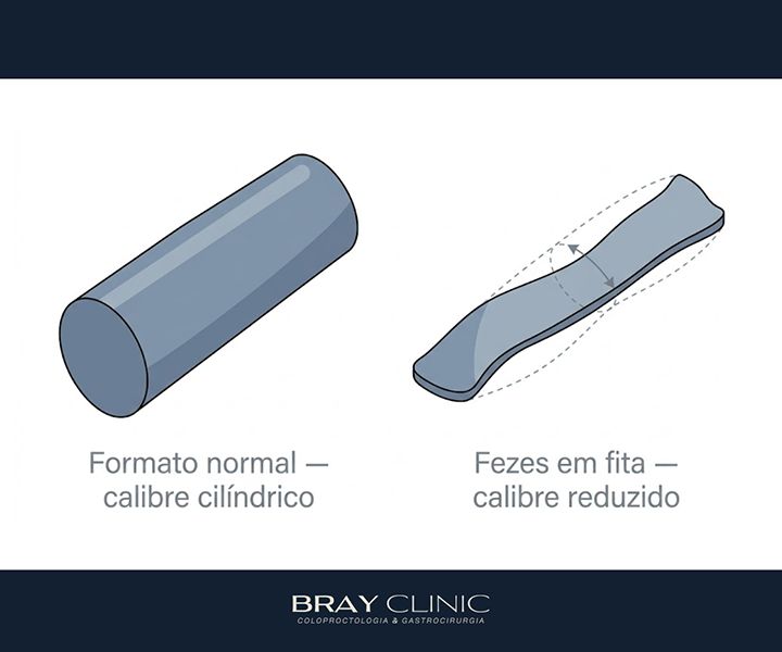 Fezes finas ou em fita: quando esse sinal merece atenção e o que fazer
