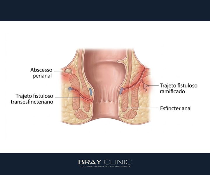 Doença de Crohn perianal: o que acontece quando a inflamação atinge a região anal?