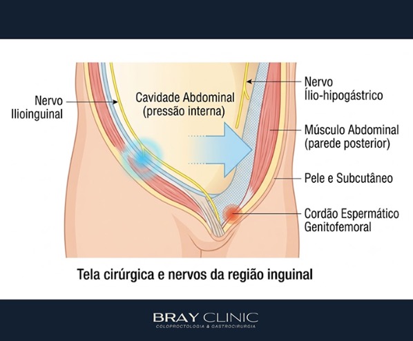 Dor após cirurgia de hérnia inguinal: quando ela se torna crônica e o que fazer?