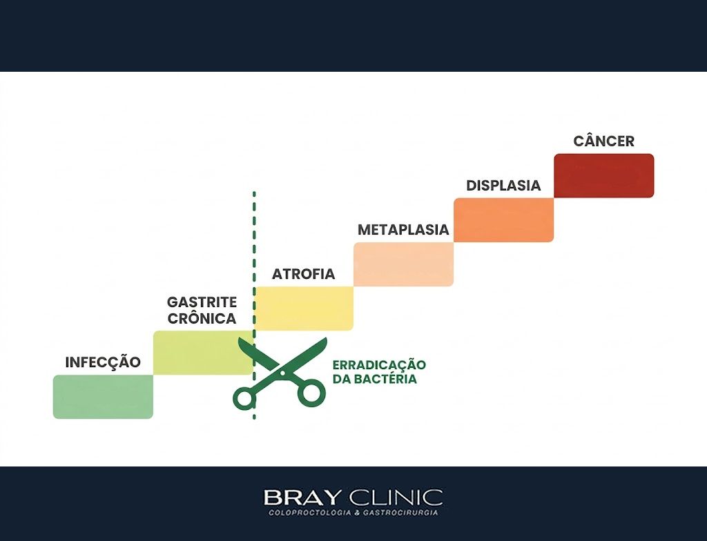 H. pylori e câncer de estômago, entenda o risco de verdade e o que fazer para reduzi-lo