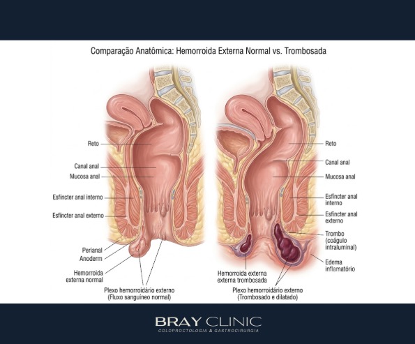 Como tratar a trombose das hemorróidas: do alívio imediato à cirurgia