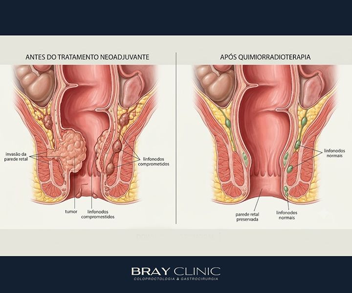 Por que preciso fazer quimioterapia e radioterapia antes de operar o câncer de reto?