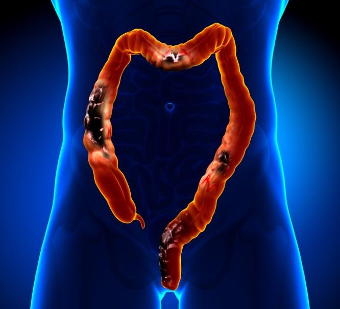 Just do it... yourself: At-home colorectal cancer screening - Harvard Health