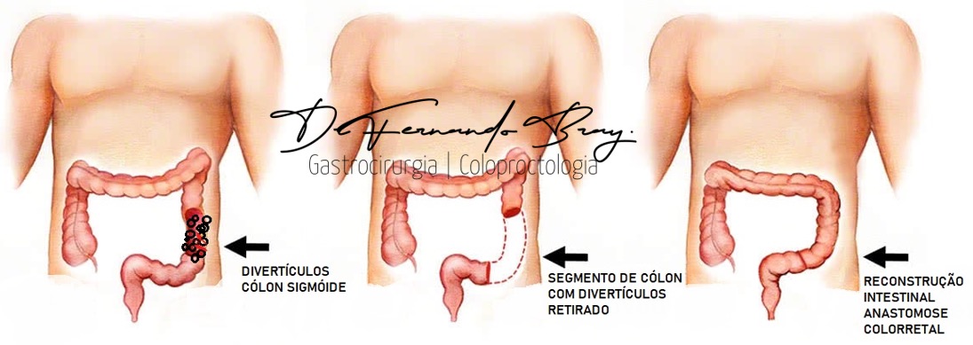 Figura 3: Ilustração demonstrando a parte do intestino grosso doente que foi retirada e juntada novamente com o reto (anastomose colorretal).