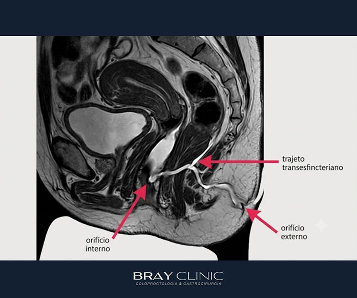 Fístula anal na doença de Crohn: por que é tão frequente e como tratar de forma eficaz