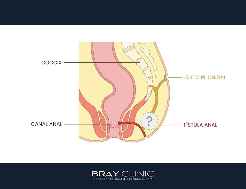 Diagnóstico do cisto pilonidal, do exame físico aos casos que pedem ultrassom e ressonância