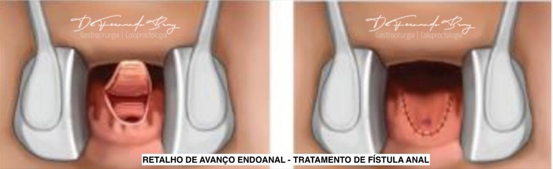 Retalho de Avanço Endoanal - Tratamento de Fístula Anal