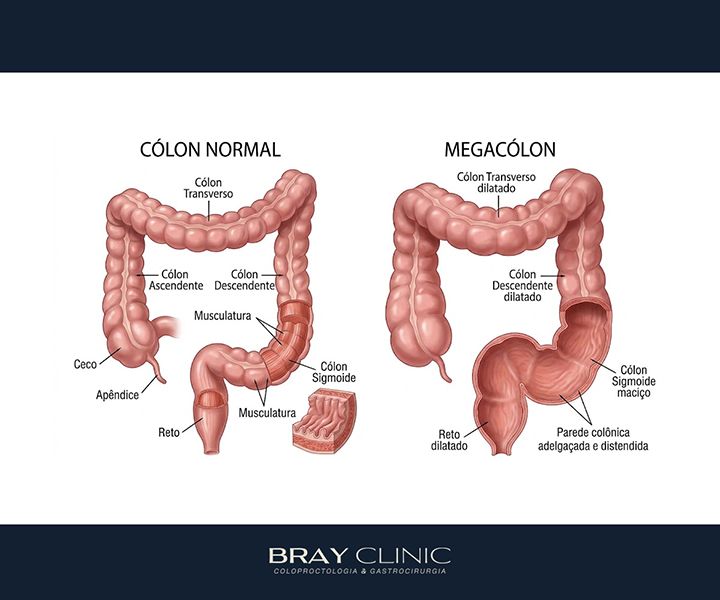Megacólon: por que o intestino dilata e o que fazer para recuperar o funcionamento