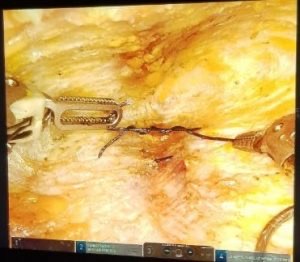 Diástase abdominal não ocorre apenas no pós-parto