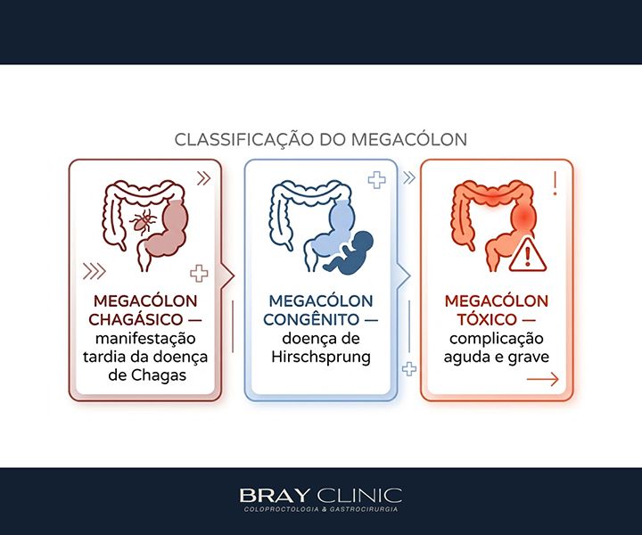 Megacólon: por que o intestino dilata e o que fazer para recuperar o funcionamento