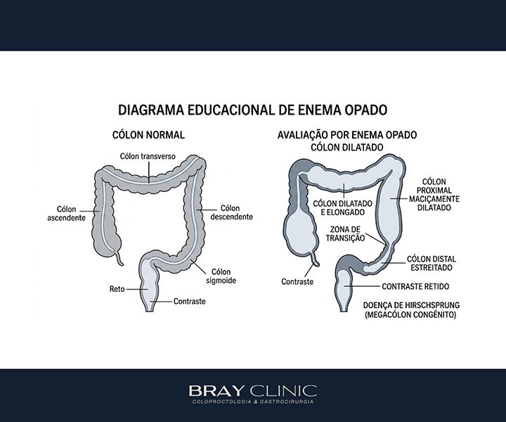 Megacólon: por que o intestino dilata e o que fazer para recuperar o funcionamento