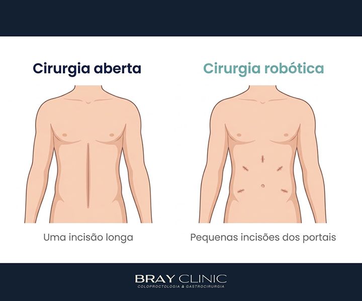 Cirurgia robótica na coloproctologia: o que muda para o paciente na prática